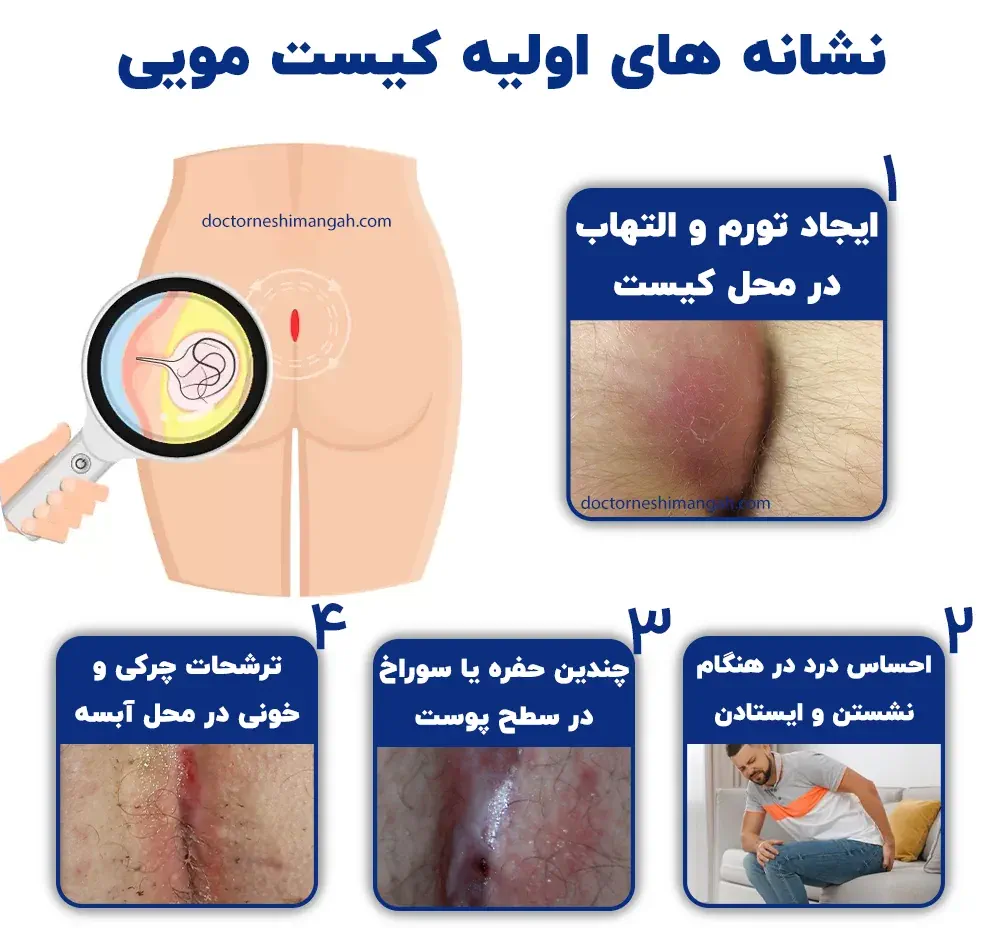 کیست مویی یا سینوس پیلونیدال چیست؟ - کلینیک التيام نشيمنگاه