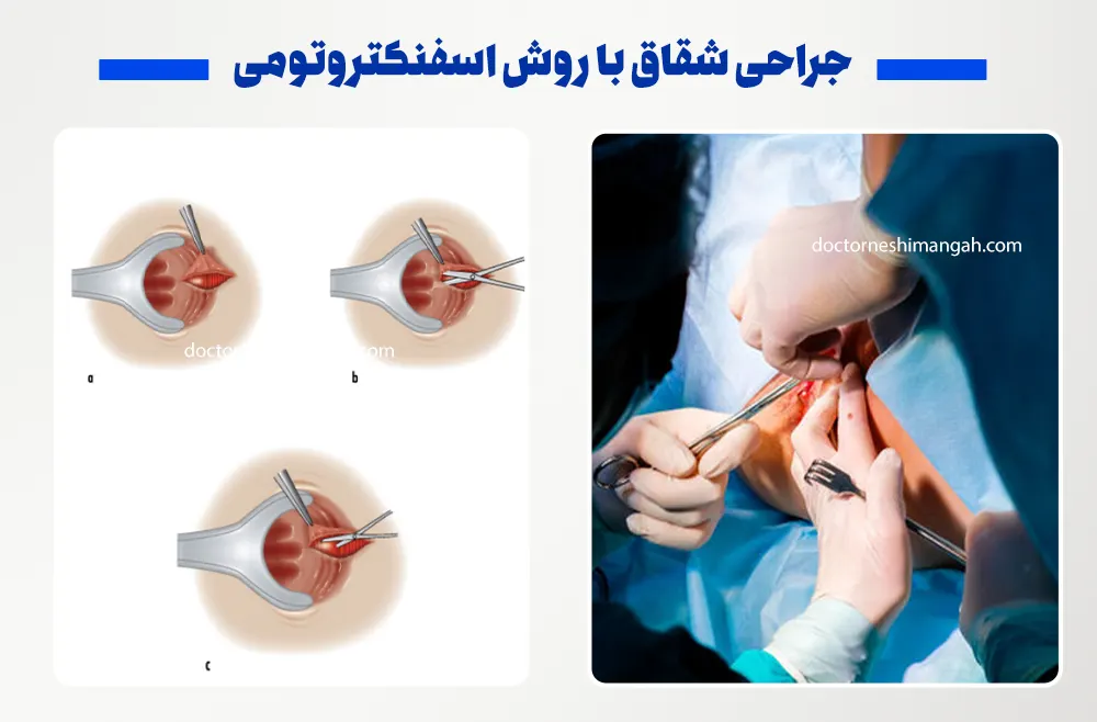 جراحی شقاق با روش اسفنکتروتومی