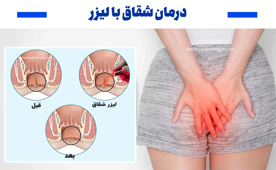 درمان شقاق با لیزر