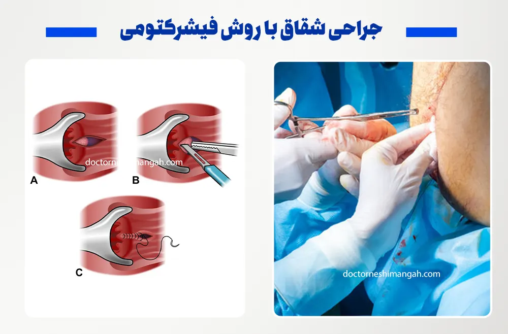 جراحی شقاق با روش فیشرکتومی