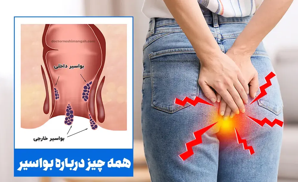 بواسیر یا هموروئید چیست؟