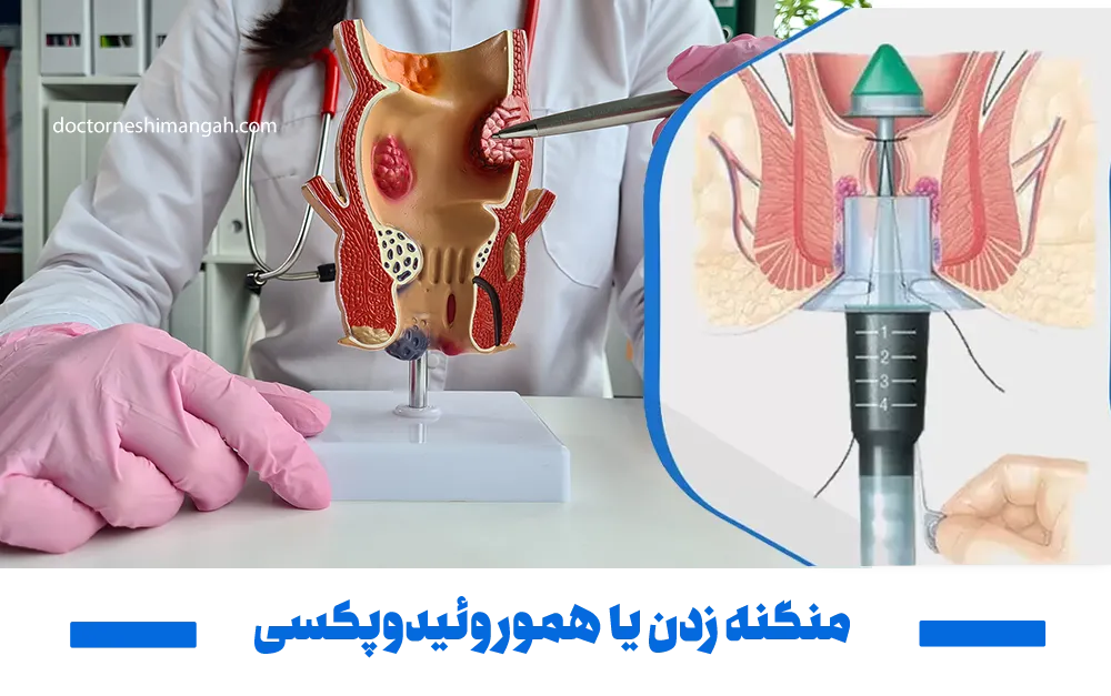منگنه زدن هموروئید یا هموروئیدوپکسی