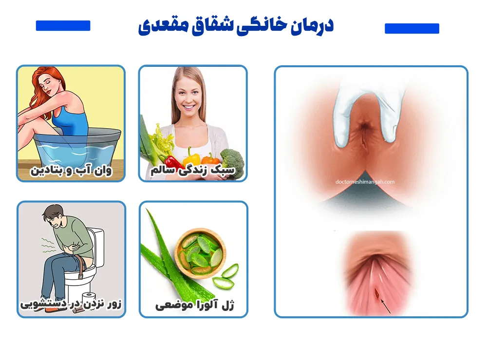 درمان خانگی شقاق مقعدی