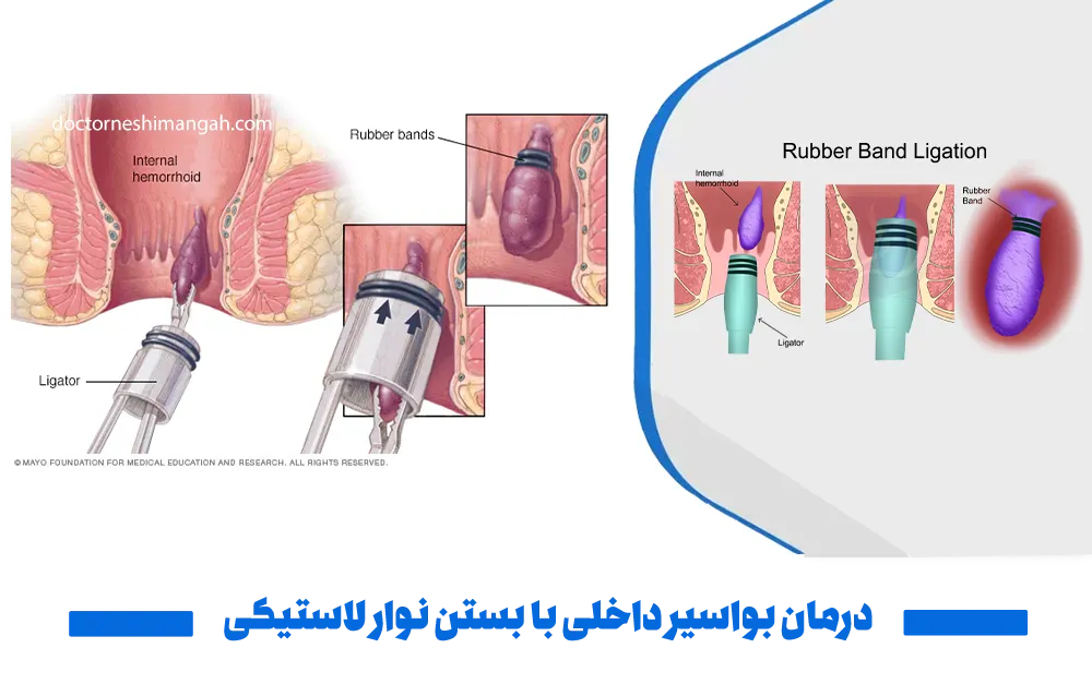 درمان بواسیر داخلی با بستن نوار لاستیکی