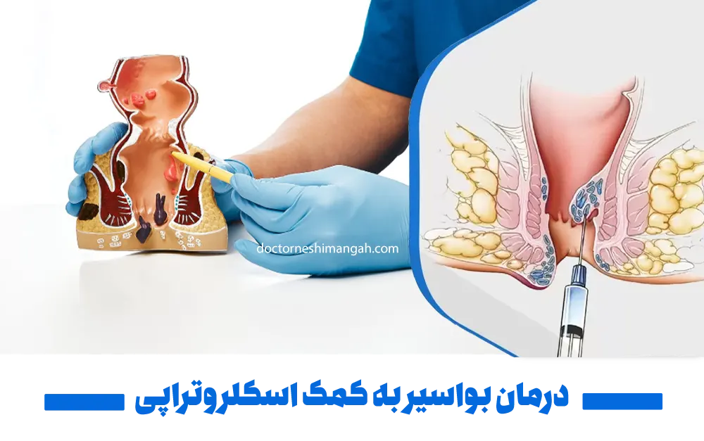 درمان بواسیر به کمک اسکلروتراپی