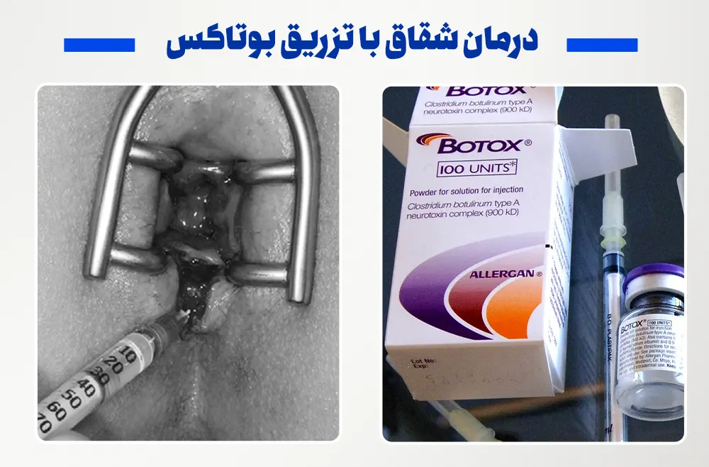 درمان شقاق با تزریق بوتاکس