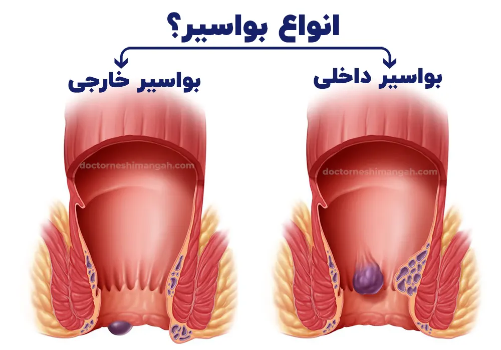انواع بواسیر