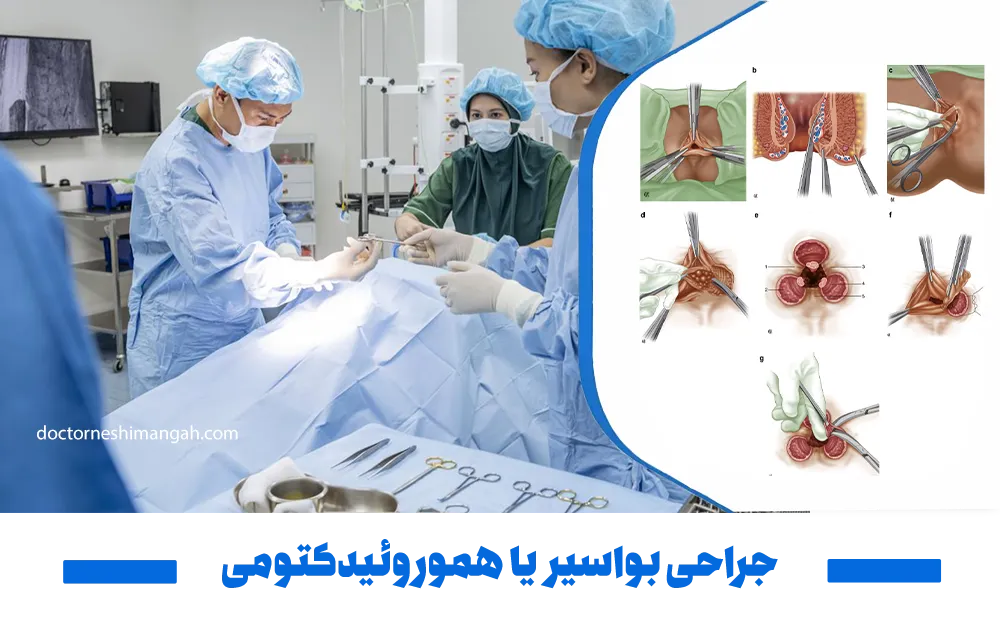 جراحی هموروئید یا هموروئیدکتومی