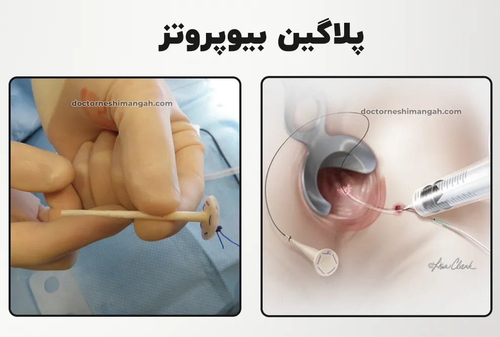 پلاگین بیوپروتز