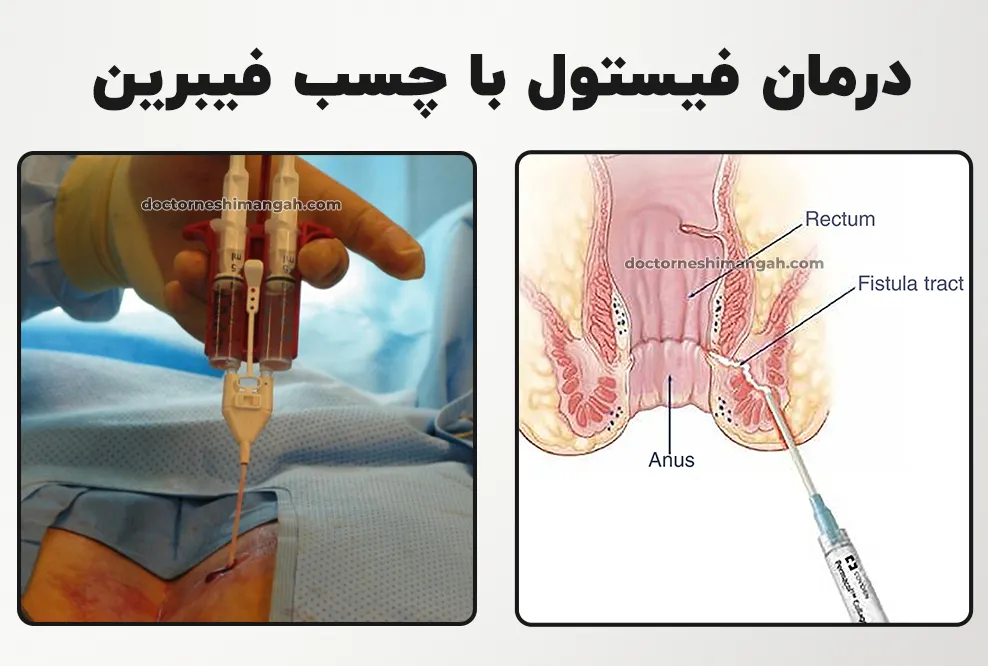 درمان فیستول با چسب فیبرین