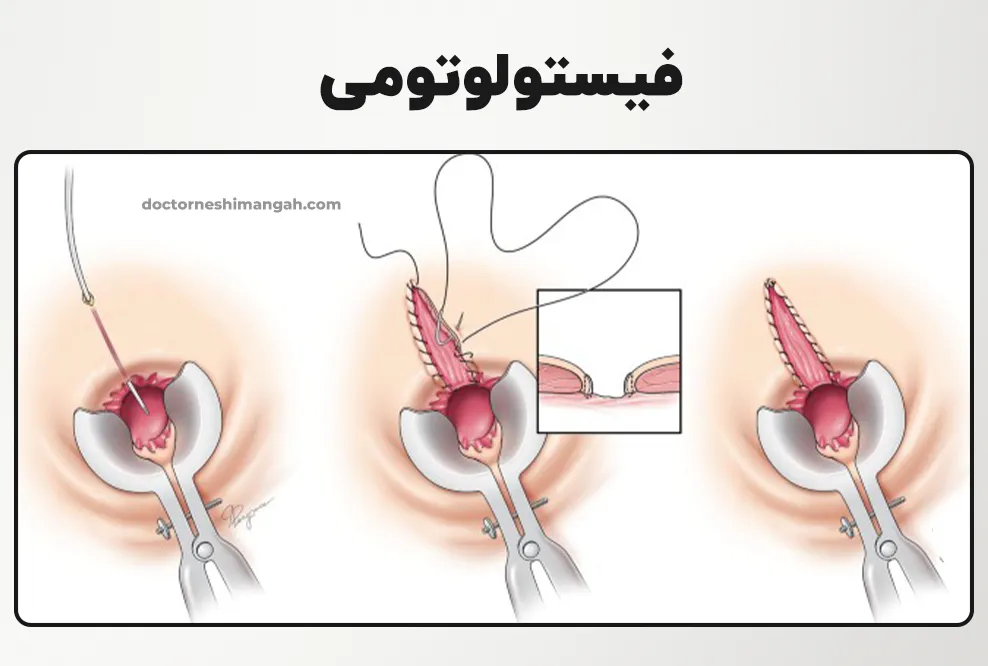 فیستولوتومی