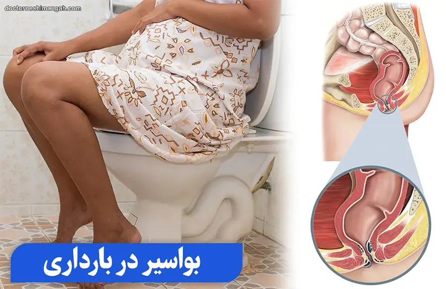 بواسیر در بارداری