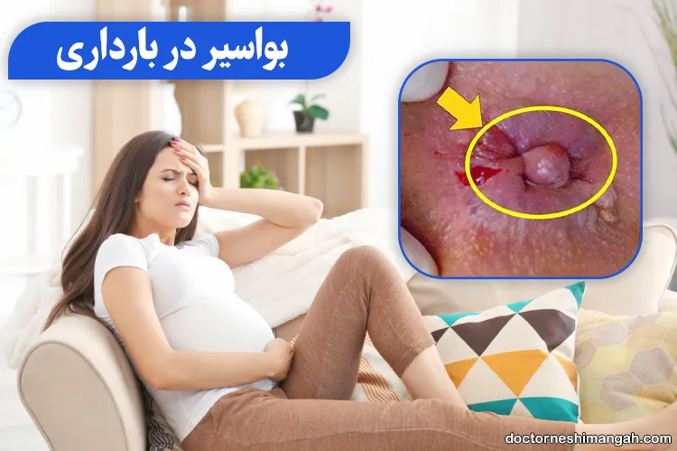 عکس بواسیر در بارداری