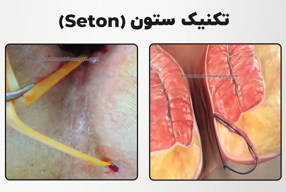 تکنیک ستون (Seton)