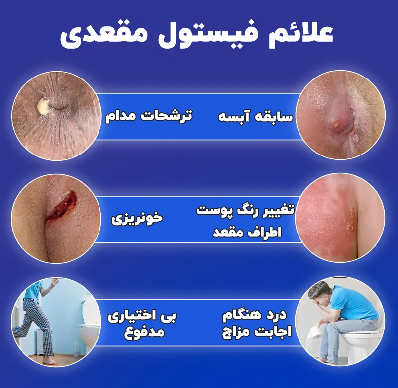 بیماری فیستول مقعدی در زنان