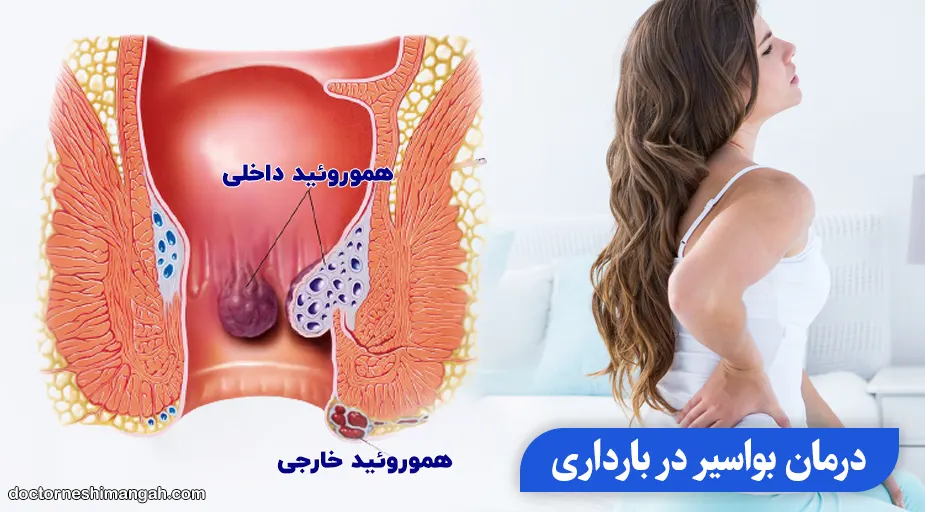 درمان بواسیر در بارداری