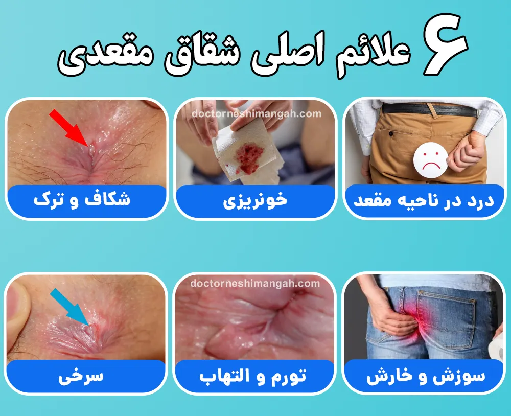 علائم اصلی شقاق مقعدی را بشناسید به همراه عکس - کلینیک التیام نشیمنگاه