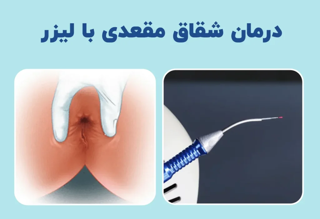 درمان شقاق مقعدی با لیزر