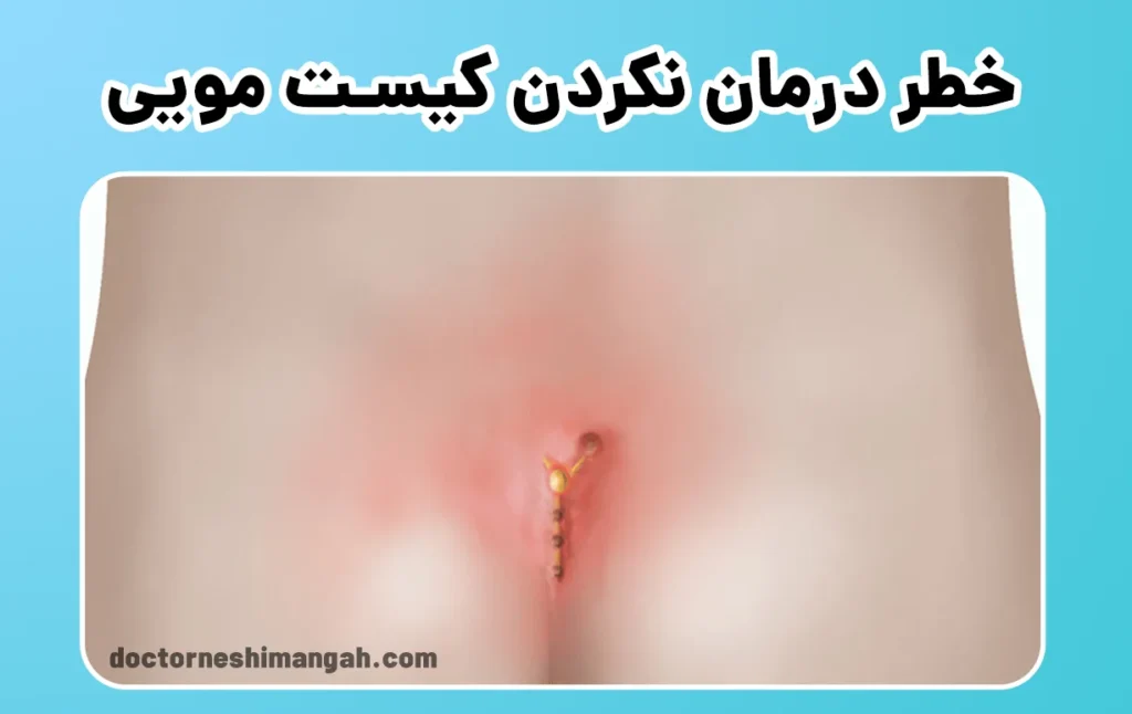 خطر درمان نکردن کیست مویی