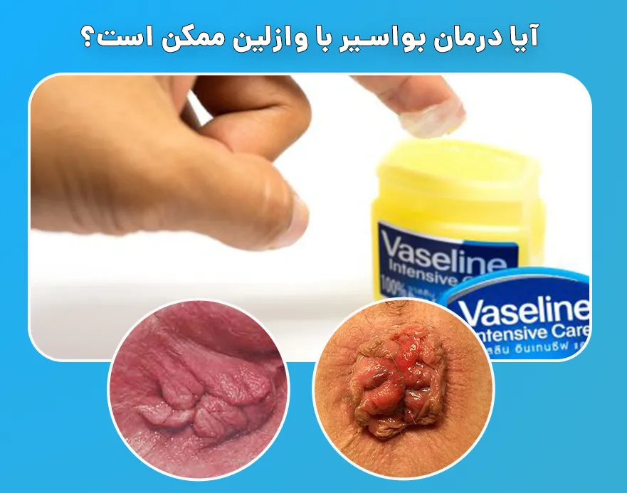 درمان بواسیر با وازلین