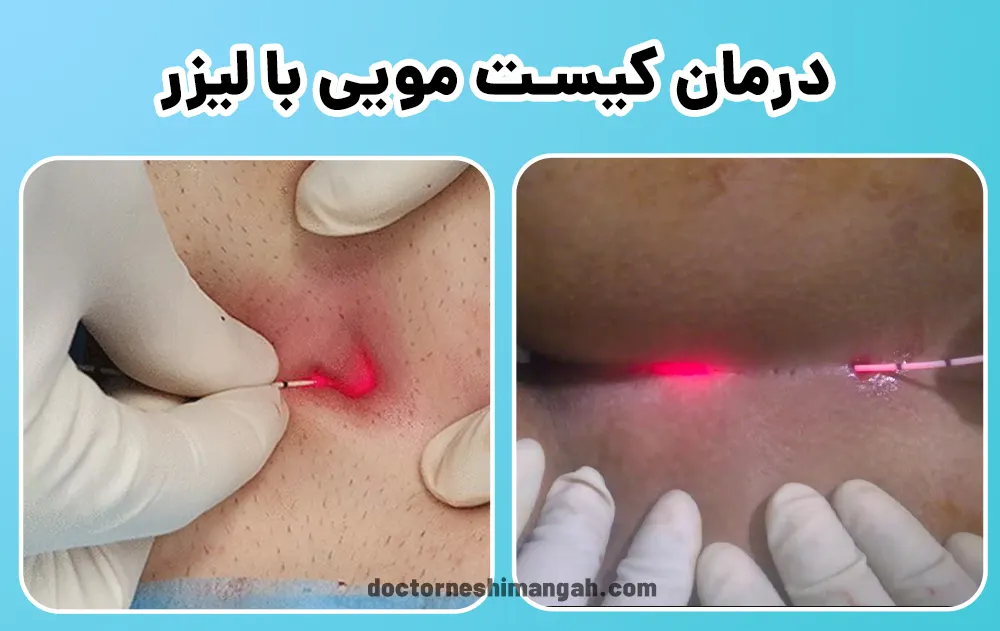 درمان کیست مویی با لیزر