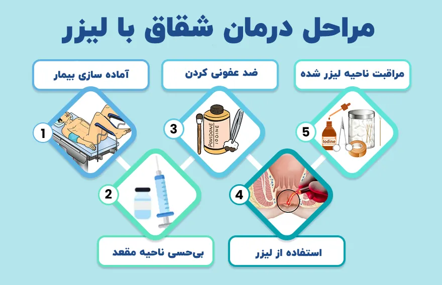 مراحل درمان شقاق با لیزر