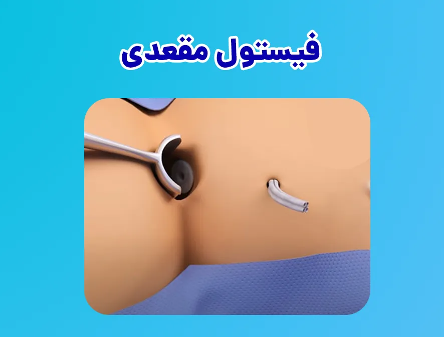 فیستول مقعدی