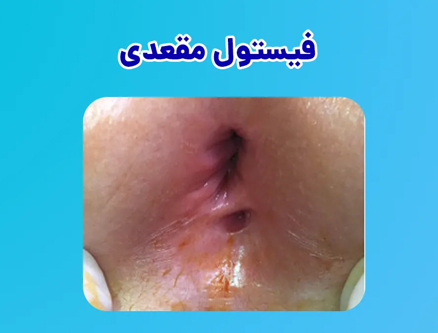 فیستول مقعدی