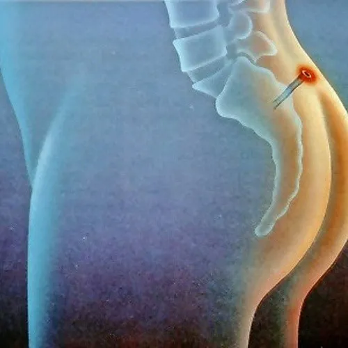 تخریب استخوان دنبالچه بر اثر کیست مویی