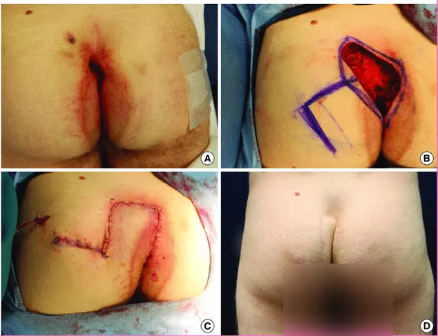 خطران عدم درمان کیست مویی