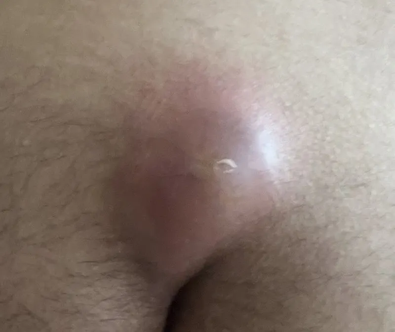 ترکیدن خود به خودی کیست مویی