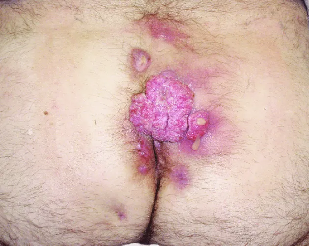 تبدیل شدن کیست مویی به سرطان پوست