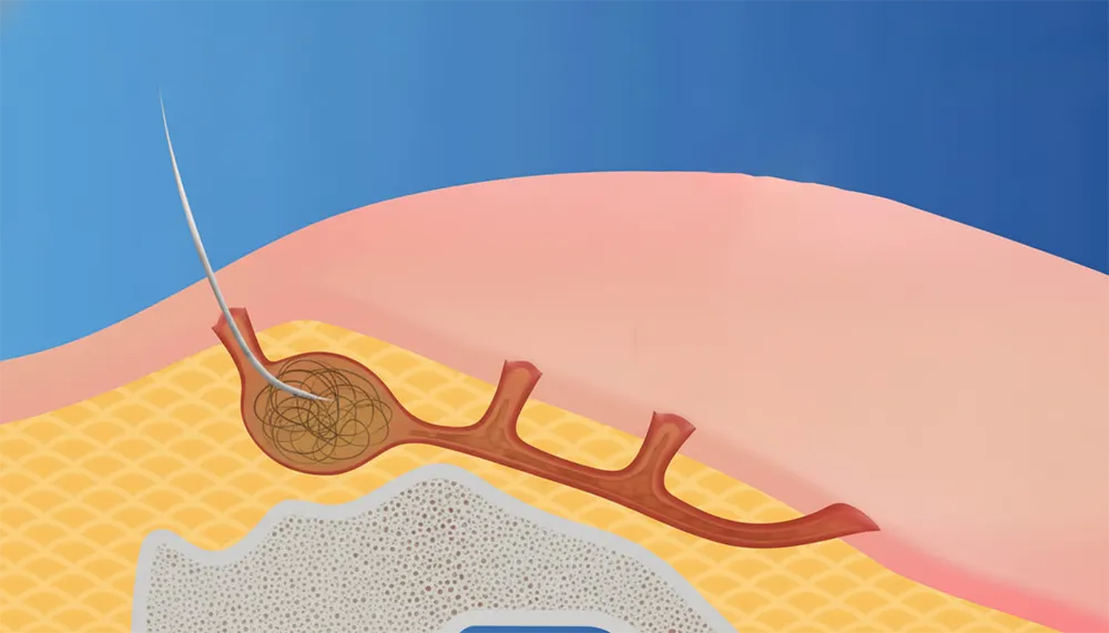 ایجاد تونل یا فیستول