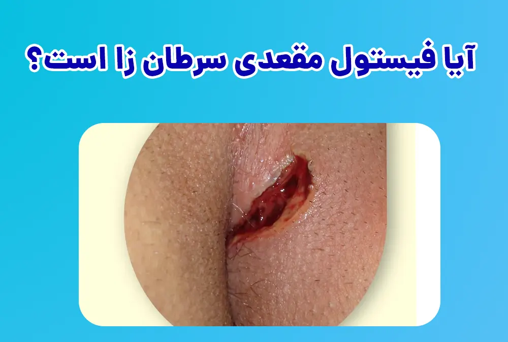 آیا فیستول مقعدی سرطان زا است؟