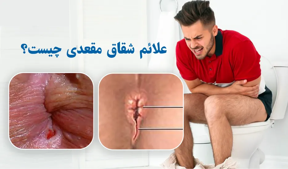 علائم شقاق مقعدی چیست؟