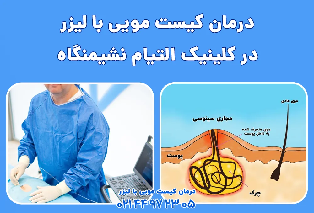 لیزر کیست مویی