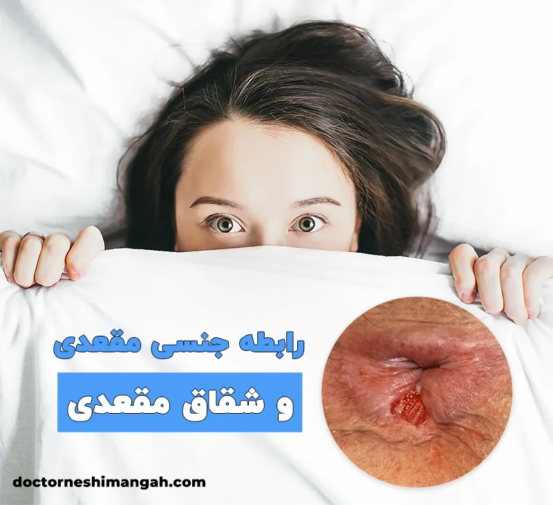 رابطه جنسی مقعدی و شقاق