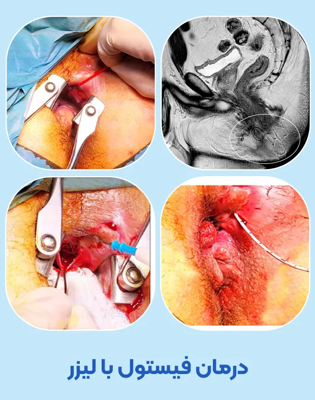 لیزر فیستول