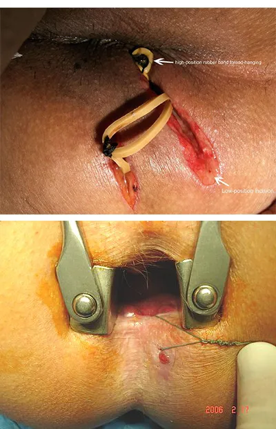 فیستول مقعد