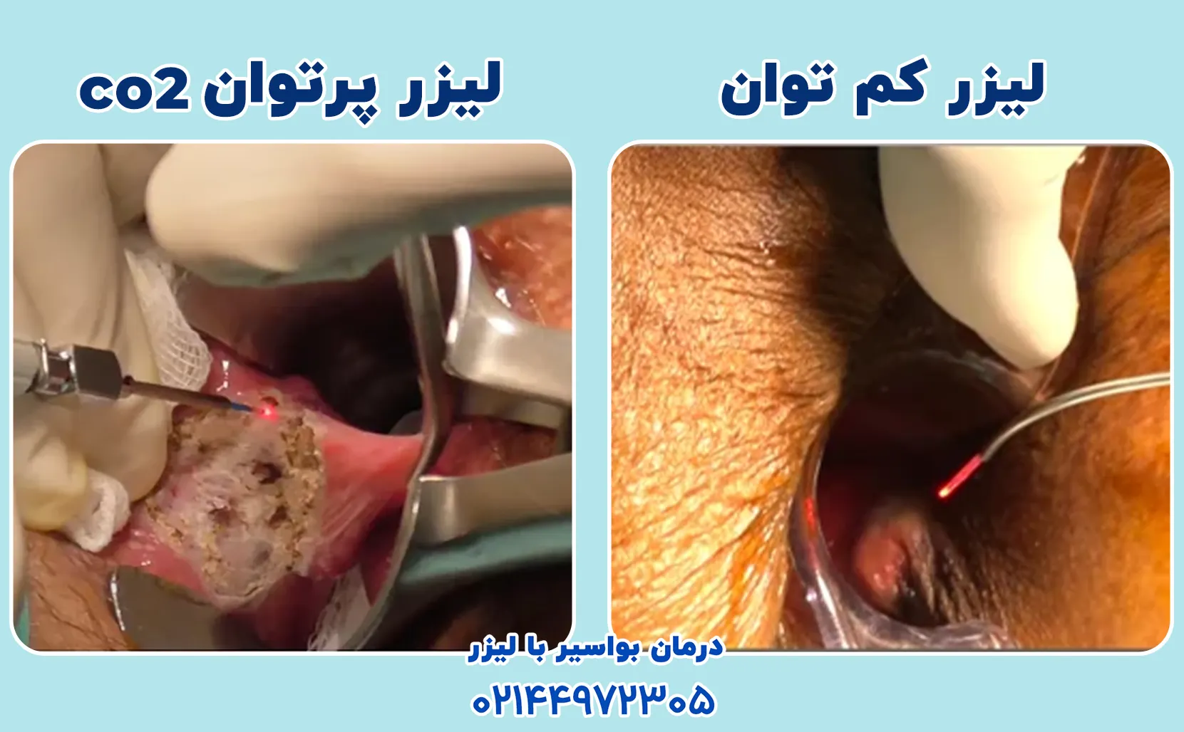هزینه لیزر گوشت اضافه مقعدی