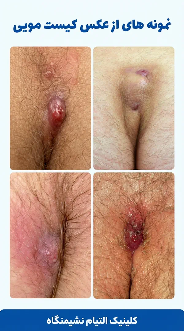 عکس کیست مویی