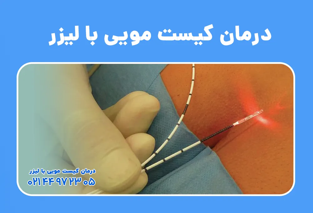 درمان کیست مویی با لیزر