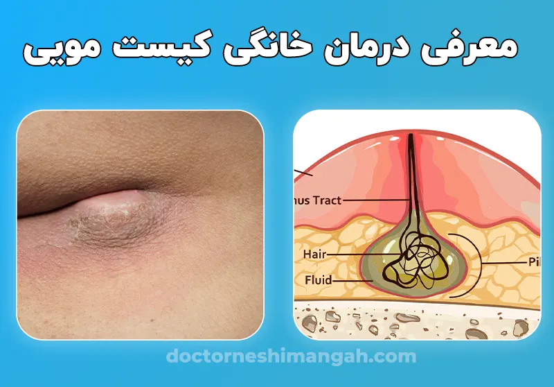 درمان خانگی کیست مویی
