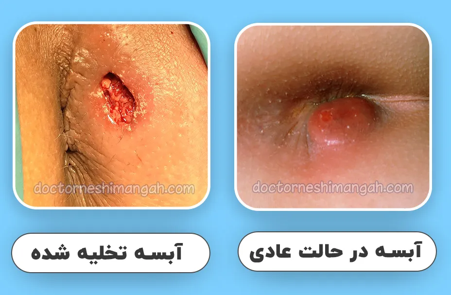 جوش مقعدی در بارداری