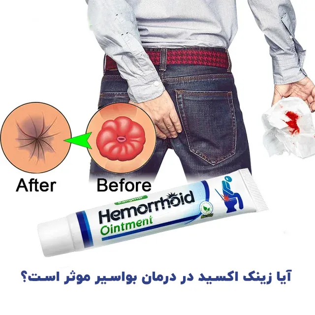 زینک اکسید در درمان بواسیر