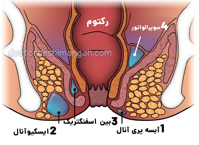 انواع آبسه مقعدی