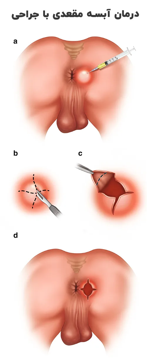 درمان آبسه مقعدی با جراحی