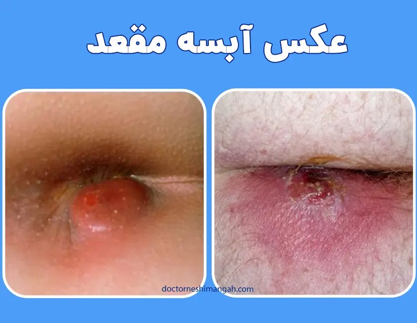 عکس آبسه مقعدی