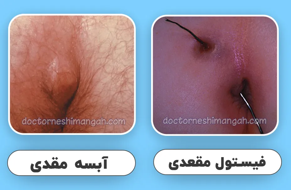 فرق آبسه مقعدی و فیستول
