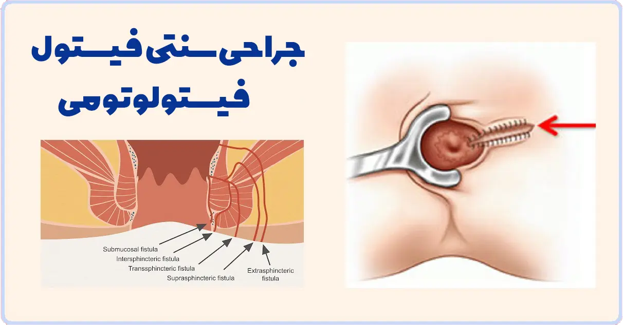 فیستولوتومی
